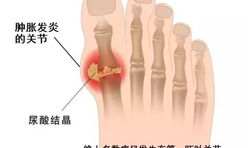 痛风吃三七粉会加重病情吗-【三七粉对痛风的功效与作用】痛风吃三七粉会加重病情吗 - 痛风中药三七粉的功效和作用网